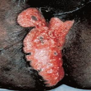 Choroby skóry narządów płciowych zdjęcia ziarniniak pachwinowy 