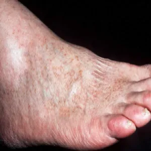 Choroby skóry stóp choroba Schamberga