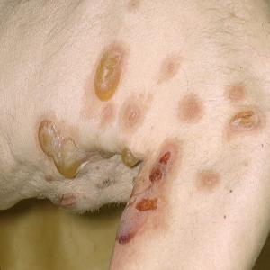 Choroby skóry zdjęcia pemfigoid pęcherzowy