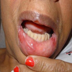 Choroby ust rumień wielopostaciowy