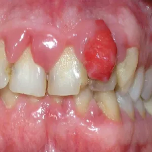 Choroby w jamie ustnej nadziąślak 