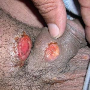 Choroby weneryczne zdjęcia ziarniniak pachwinowy 