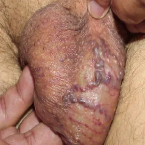 Choroby worka mosznowego rogowiec krwawy