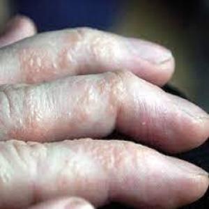Choroby skórne na palcach