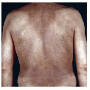 Ciemna skóra choroba amyloidozy skóry