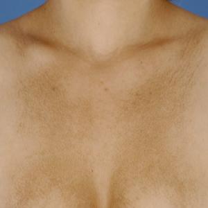 Ciemniejsza skóra na klatce piersiowej choroba amyloidozy skóry 