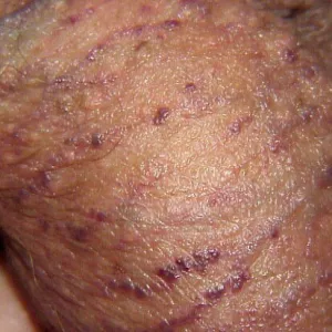 Ciemno czerwone guzki na mosznie rogowiec krwawy