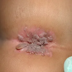 Condylomata acuminata
