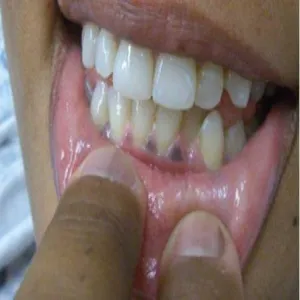 Czarne dziąsła choroba Addisona