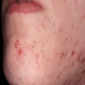 Czarne kropki na twarzy zaskórniki otwarte