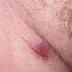 Czerniak miejsc intymnych