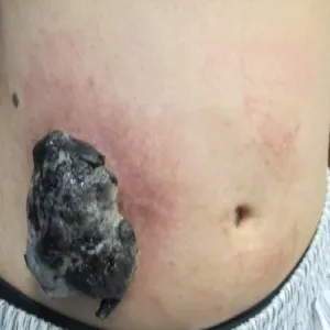 Czerniak złośliwy na brzuchu