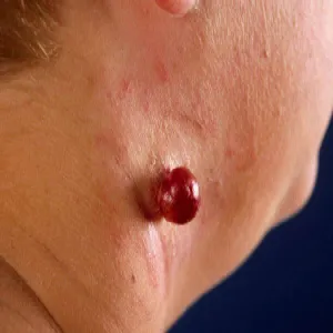 Czerwona narośl na szyi
