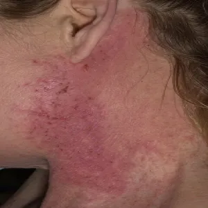 Czerwona plama na szyi choroba Dariera