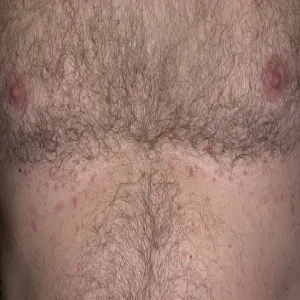 Czerwona wysypka choroba Grovera