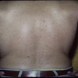 Czerwona wysypka grudkowa na plecach choroba Grovena