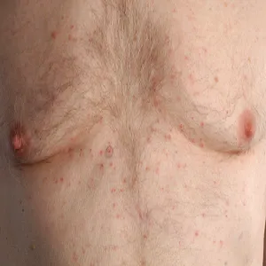 Czerwona wysypka na klatce piersiowej choroba Grovena