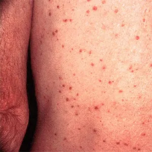 Czerwone krostki na ciele u dorosłych choroba Grovera