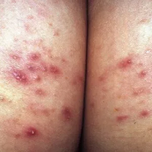 Czerwone krosty na pośladkach zapalenie mieszków włosowych