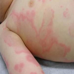 Czerwone plamy na ciele dziecka pokrzywka alergiczna