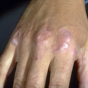 Czerwone plamy na dłoni choroba ziarniniak obrączkowaty 
