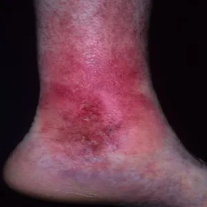 Czerwone plamy na nogach wyprysk podudzi