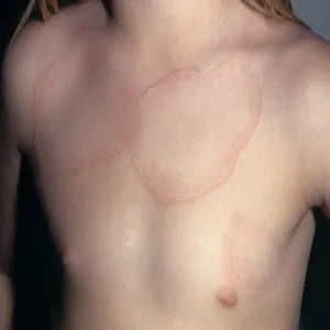 Czerwone plamy na skórze klatki piersiowej ziarniniak obrączkowaty 