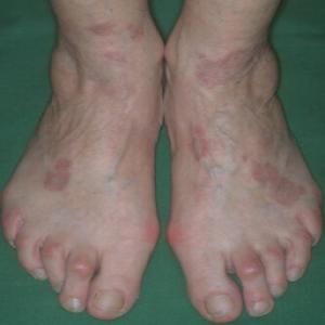 Czerwone plamy na stopach choroba ziarniniak obrączkowaty 