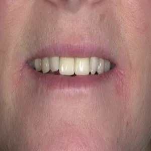 Czerwone suche plamy w kącikach ust