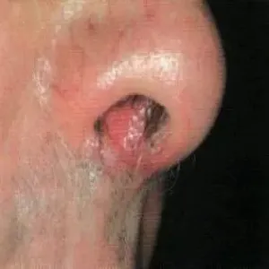 Czyrak przedsionka nosa