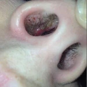 Czyrak przegrody nosowej