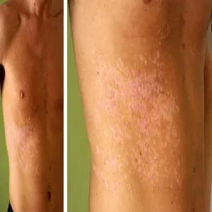 Darier-White disease