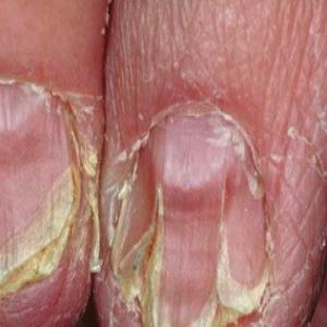 Deformacja paznokci choroba Dariera
