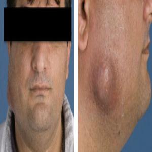 Deformacja twarzy podczas choroby promienicy