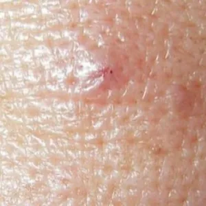 Demodex brevis nużeniec