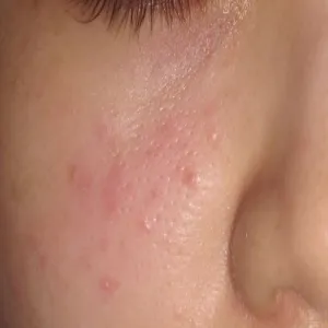 Demodex folliculorum nużeniec