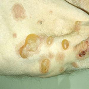 Dermatoza pęcherzowa pemfigoid pęcherzowy