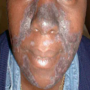 Discoid lupus erythematosus