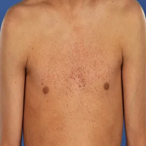 Drobna wysypka skórna choroba Fabry'ego