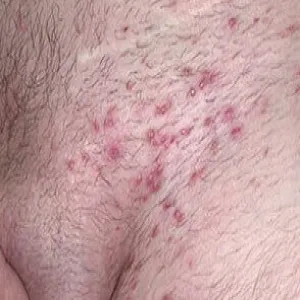 Duże ropne krosty w okolicach intymnych