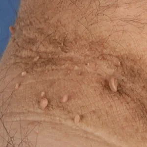 Dzyndzelki na skórze choroba włókniaki