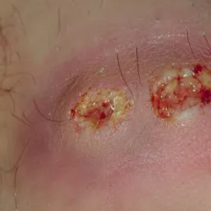 Ecthyma paciorkowiec ropotwórczy 