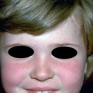 Erythema infectiosum
