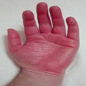 Erytromelalgia