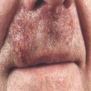 Figówka choroba skóry