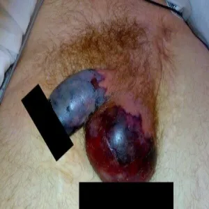 Fournier gangrene