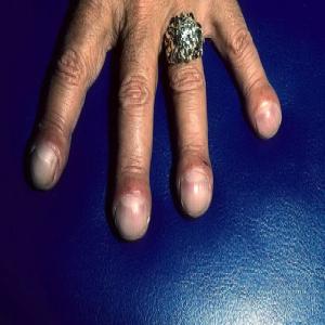 Górki na paznokciach pałeczkowatość palców 