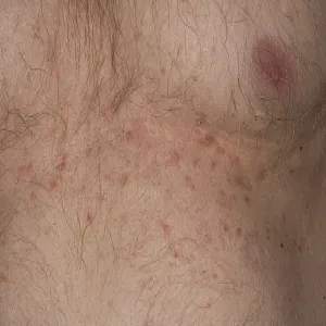 Gęsta wysypka jaskrawoczerwonych grudek na skórze choroba Grovena