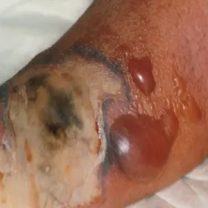 Gangrena mokra na nodze zdjęcia