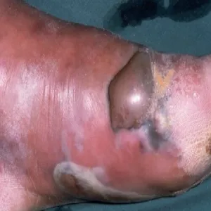 Gangrena zgorzel gazowa  na nodze zdjęcia